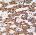 PHB / Prohibitin Antibody - Formalin-fixed and paraffin-embedded human hepatocarcinoma tissue reacted with PHB antibody , which was peroxidase-conjugated to the secondary antibody, followed by DAB staining. This data demonstrates the use of this antibody for immunohistochemistry; clinical relevance has not been evaluated.