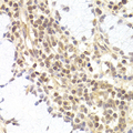 PHC1 / EDR1 Antibody - Immunohistochemistry of paraffin-embedded human adenomyosis.