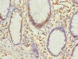 PHF10 Antibody - Immunohistochemistry of paraffin-embedded human colon cancer using antibody at dilution of 1:100.