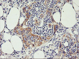 PHF21B Antibody - IHC of paraffin-embedded Carcinoma of Human pancreas tissue using anti-PHF21B mouse monoclonal antibody.