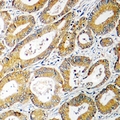 PHYKPL / AGXT2L2 Antibody - Immunohistochemical analysis of AGXT2L2 staining in human colon cancer formalin fixed paraffin embedded tissue section. The section was pre-treated using heat mediated antigen retrieval with sodium citrate buffer (pH 6.0). The section was then incubated with the antibody at room temperature and detected with HRP and DAB as chromogen. The section was then counterstained with hematoxylin and mounted with DPX.