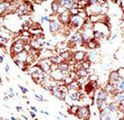 PIAS1 Antibody - Formalin-fixed and paraffin-embedded human cancer tissue reacted with the primary antibody, which was peroxidase-conjugated to the secondary antibody, followed by DAB staining. This data demonstrates the use of this antibody for immunohistochemistry; clinical relevance has not been evaluated. BC = breast carcinoma; HC = hepatocarcinoma.