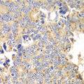 PICK1 Antibody - Immunohistochemistry of paraffin-embedded human prostate cancer tissue.