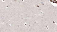 PIEZO1 / FAM38A Antibody - 1:100 staining human brain carcinoma tissue by IHC-P. The sample was formaldehyde fixed and a heat mediated antigen retrieval step in citrate buffer was performed. The sample was then blocked and incubated with the antibody for 1.5 hours at 22°C. An HRP conjugated goat anti-rabbit antibody was used as the secondary.