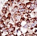 PIGK Antibody - Formalin-fixed and paraffin-embedded human cancer tissue reacted with the primary antibody, which was peroxidase-conjugated to the secondary antibody, followed by DAB staining. This data demonstrates the use of this antibody for immunohistochemistry; clinical relevance has not been evaluated. BC = breast carcinoma; HC = hepatocarcinoma.