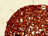 PIGK Antibody - Immunohistochemistry of paraffin-embedded human breast cancer at dilution of 1:100