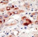 PIK3C3 / VPS34 Antibody - Formalin-fixed and paraffin-embedded human cancer tissue reacted with the primary antibody, which was peroxidase-conjugated to the secondary antibody, followed by DAB staining. This data demonstrates the use of this antibody for immunohistochemistry; clinical relevance has not been evaluated. BC = breast carcinoma; HC = hepatocarcinoma.