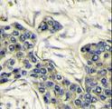 PIK3CA / PI3K Alpha Antibody - Formalin-fixed and paraffin-embedded human breast carcinoma reacted with PI3KCA Antibody , which was peroxidase-conjugated to the secondary antibody, followed by DAB staining. This data demonstrates the use of this antibody for immunohistochemistry; clinical relevance has not been evaluated.