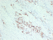 PIK3CA / PI3K Alpha Antibody - Gastric Adenocarcinoma 2