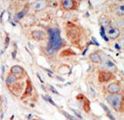 PIK3CD / PI3K Delta Antibody - Formalin-fixed and paraffin-embedded human cancer tissue reacted with the primary antibody, which was peroxidase-conjugated to the secondary antibody, followed by DAB staining. This data demonstrates the use of this antibody for immunohistochemistry; clinical relevance has not been evaluated. BC = breast carcinoma; HC = hepatocarcinoma.