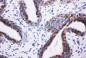 PIK3R2 / p85 Beta Antibody - PIK3R2 / p85 Beta antibody. IHC(P): Human Breast Cancer Tissue.