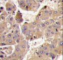PIK3R3 / p85 Gamma Antibody - Formalin-fixed and paraffin-embedded human hepatocarcinoma tissue reacted with PIK3R3 antibody , which was peroxidase-conjugated to the secondary antibody, followed by DAB staining. This data demonstrates the use of this antibody for immunohistochemistry; clinical relevance has not been evaluated.