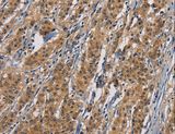 PIKFYVE / PIP5K Antibody - Immunohistochemistry of paraffin-embedded Human gastric cancer using PIKFYV Polyclonal Antibody at dilution of 1:50.