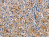 PIKFYVE / PIP5K Antibody - Immunohistochemistry of paraffin-embedded Human liver cancer using PIKFYV Polyclonal Antibody at dilution of 1:30.