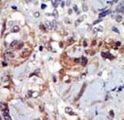 PIP4K2A / PIPK Antibody - Formalin-fixed and paraffin-embedded human cancer tissue reacted with the primary antibody, which was peroxidase-conjugated to the secondary antibody, followed by AEC staining. This data demonstrates the use of this antibody for immunohistochemistry; clinical relevance has not been evaluated. BC = breast carcinoma; HC = hepatocarcinoma.