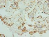 PKD1L2 Antibody - Immunohistochemistry of paraffin-embedded human breast cancer using antibody at dilution of 1:100.