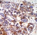 PKG / PRKG1 Antibody - Formalin-fixed and paraffin-embedded human cancer tissue reacted with the primary antibody, which was peroxidase-conjugated to the secondary antibody, followed by AEC staining. This data demonstrates the use of this antibody for immunohistochemistry; clinical relevance has not been evaluated. BC = breast carcinoma; HC = hepatocarcinoma.