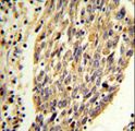PKM / Pyruvate Kinase, Muscle Antibody - PKM2 (N-term E131) Antibody IHC of formalin-fixed and paraffin-embedded human lung carcinoma followed by peroxidase-conjugated secondary antibody and DAB staining. This data demonstrates the use of the PKM2 (N-term E131) Antibody for immunohistochemistry.