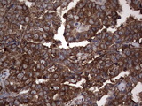 PKM2 Antibody - IHC of paraffin-embedded Adenocarcinoma of Human ovary tissue using anti-PKM2 Mouse monoclonal antibody.