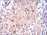 PKN2 Antibody - IHC of paraffin-embedded lung cancer tissues using PRK2 mouse monoclonal antibody with DAB staining.