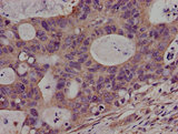 PKN2 Antibody - Immunohistochemistry image of paraffin-embedded human colon cancer at a dilution of 1:100
