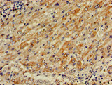 PLA2G10 Antibody - Immunohistochemistry of paraffin-embedded human liver cancer using PLA2G10 Antibody at dilution of 1:100