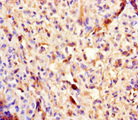 PLA2G2D Antibody - Immunohistochemistry of paraffin-embedded human melanoma using PLA2G2D Antibody at dilution of 1:100