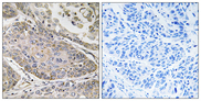 PLA2G4E Antibody - Immunohistochemistry analysis of paraffin-embedded human lung carcinoma, using PLA2G4E Antibody. The picture on the right is blocked with the synthesized peptide.