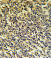 PLA2G6 / IPLA2 Antibody - PLA2G6 Antibody IHC of formalin-fixed and paraffin-embedded testis carcinoma followed by peroxidase-conjugated secondary antibody and DAB staining.