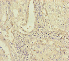 PLAA Antibody - Immunohistochemistry of paraffin-embedded human lung cancer at dilution of 1:100