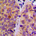 PLCG2 / PLC Gamma 2 Antibody - Immunohistochemical analysis of PLC gamma 2 (pY753) staining in human breast cancer formalin fixed paraffin embedded tissue section. The section was pre-treated using heat mediated antigen retrieval with sodium citrate buffer (pH 6.0). The section was then incubated with the antibody at room temperature and detected using an HRP conjugated compact polymer system. DAB was used as the chromogen. The section was then counterstained with hematoxylin and mounted with DPX.