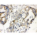 PLEC / Plectin Antibody - Plectin antibody IHC-paraffin. IHC(P): Human Intestinal Cancer Tissue.