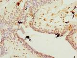PLET1 / C11orf34 Antibody - Immunohistochemistry of paraffin-embedded human breast cancer using antibody at dilution of 1:100.