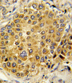 PLG / Plasmin / Plasminogen Antibody - Formalin-fixed and paraffin-embedded human hepatocarcinoma reacted with PLG Antibody , which was peroxidase-conjugated to the secondary antibody, followed by DAB staining. This data demonstrates the use of this antibody for immunohistochemistry; clinical relevance has not been evaluated.