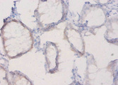 PLXNA1 / Plexin A1 Antibody - Immunohistochemistry of paraffin-embedded human colon cancer using PLXNA1 Antibody at dilution of 1:20