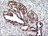 PMS2 Antibody - IHC of paraffin-embedded Adenocarcinoma of Human ovary tissue using anti-PMS2 mouse monoclonal antibody. (Heat-induced epitope retrieval by 10mM citric buffer, pH6.0, 120°C for 3min).