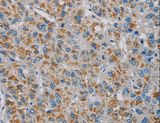 PNLIP / PL / Pancreatic Lipase Antibody - Immunohistochemistry of paraffin-embedded Human liver cancer using PNLIP Polyclonal Antibody at dilution of 1:20.