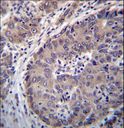 PNLIPRP3 Antibody - PNLIPRP3 Antibody immunohistochemistry of formalin-fixed and paraffin-embedded human hepatocarcinoma followed by peroxidase-conjugated secondary antibody and DAB staining.