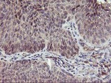 PNMT Antibody - IHC of paraffin-embedded Carcinoma of Human bladder tissue using anti-PNMT mouse monoclonal antibody.