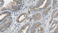 PNMT Antibody - 1:100 staining human prostate tissue by IHC-P. The sample was formaldehyde fixed and a heat mediated antigen retrieval step in citrate buffer was performed. The sample was then blocked and incubated with the antibody for 1.5 hours at 22°C. An HRP conjugated goat anti-rabbit antibody was used as the secondary.