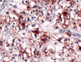 PODXL / Podocalyxin Antibody - Immunohistochemistry of Human Renal Cell Carcinoma stained with anti-GP200 (Renal Cell Carcinoma Marker) antibody