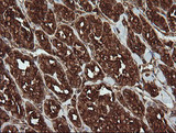 POGK Antibody - IHC of paraffin-embedded Carcinoma of Human thyroid tissue using anti-POGK mouse monoclonal antibody.