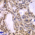 POLD3 Antibody - Immunohistochemistry of paraffin-embedded human oophoroma tissue.
