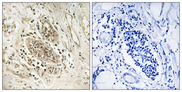 POLE / POLE1 Antibody - Immunohistochemistry analysis of paraffin-embedded human breast carcinoma tissue, using POLE1 Antibody. The picture on the right is blocked with the synthesized peptide.