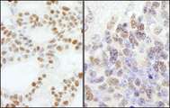 POLE3 / DNA Polymerase Epsilon Antibody - Detection of Human and Mouse PolE3/p17 by Immunohistochemistry. Sample: FFPE section of human ovarian carcinoma (left) and mouse teratoma (right). Antibody: Affinity purified rabbit anti-PolE3/p17 used at a dilution of 1:5000 (0.2 ug/ml). Detection: DAB.