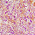 POLG2 Antibody - Immunohistochemical analysis of DNA Polymerase gamma 2 staining in human breast cancer formalin fixed paraffin embedded tissue section. The section was pre-treated using heat mediated antigen retrieval with sodium citrate buffer (pH 6.0). The section was then incubated with the antibody at room temperature and detected using an HRP-conjugated compact polymer system. DAB was used as the chromogen. The section was then counterstained with hematoxylin and mounted with DPX.