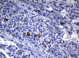 POLI Antibody - IHC of paraffin-embedded Carcinoma of Human liver tissue using anti-POLI mouse monoclonal antibody.