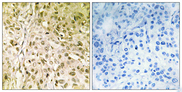 POLQ / DNA Polymerase Theta Antibody - Immunohistochemistry analysis of paraffin-embedded human breast carcinoma, using DNA Polymerase thet Antibody. The picture on the right is blocked with the synthesized peptide.