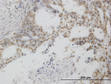 POLR1C / RPA39 Antibody - Immunoperoxidase of monoclonal antibody to POLR1C on formalin-fixed paraffin-embedded human pancreatic cancer. [antibody concentration 0.6 ug/ml]