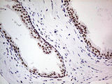 POLR2A / RNA polymerase II Antibody - Immunohistochemical staining of paraffin-embedded Carcinoma of Human prostate tissue using anti-POLR2A mouse monoclonal antibody. (Heat-induced epitope retrieval by 1mM EDTA in 10mM Tris buffer. (pH8.5) at 120°C for 3 min. (1:500)